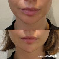 Контурная пластика photo