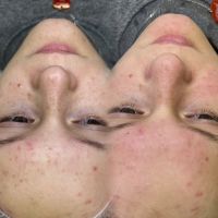 Чистка лица photo