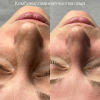 Чистка лица photo