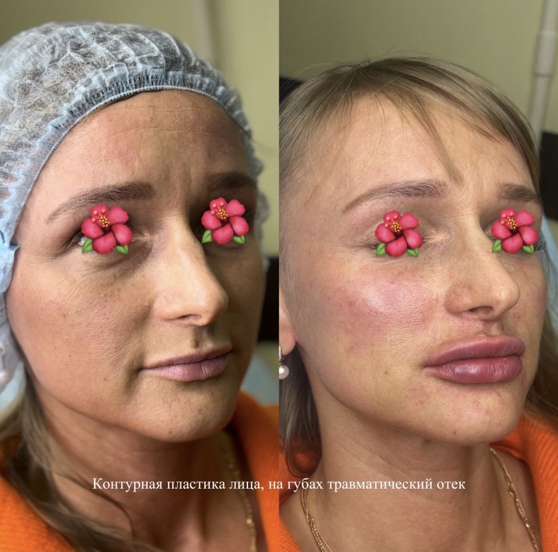 Контурная пластика