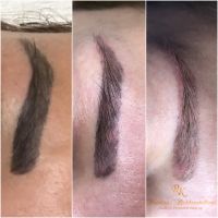 Удаление татуажа photo