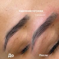 Удаление татуажа