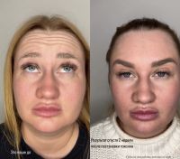 Ботулинотерапия photo