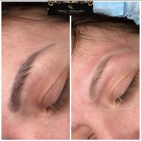 Удаление татуажа photo