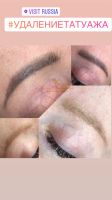 Удаление татуажа photo
