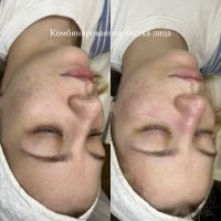 Чистка лица photo