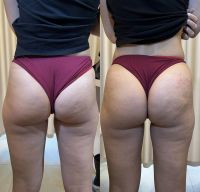 Увеличение ягодиц photo