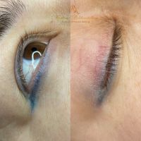 Удаление татуажа photo