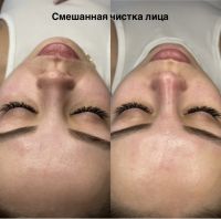 Чистка лица photo