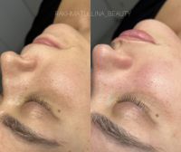 Чистка лица