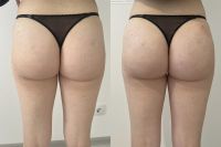 Увеличение ягодиц photo