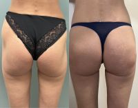 Увеличение ягодиц photo